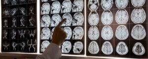 La Resonancia Magnética cerebral como herramienta de investigación